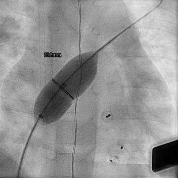 Fechamento Percutâneo de Shunts Intracardíacos Múltiplos em Paciente Pediátrico